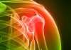 Arthritis